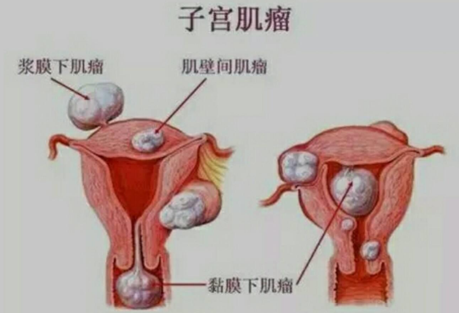 <b>子宫腺肌症是什么病，有什么症状？这些知识女性须知</b>