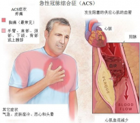 一篇文章带你详细了解急性冠脉综合征的诊断及治疗，万一遇到了千万不要慌