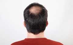 人到中年脱发多，治疗脂溢性脱发有什么方法