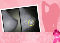 怎么区分乳腺还是肿块 辨别方法奉上